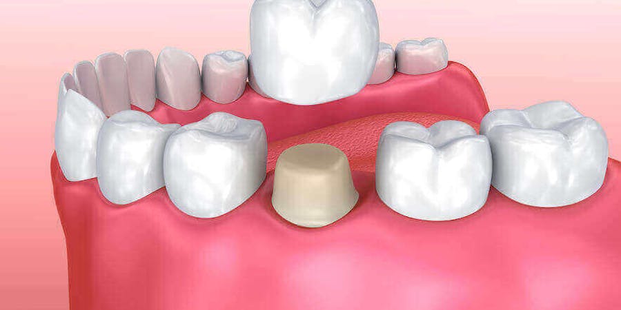 Dental Crowns Mississauga