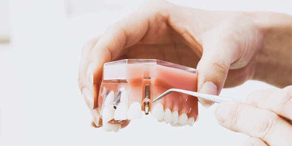 Dental Implants Mississauga
