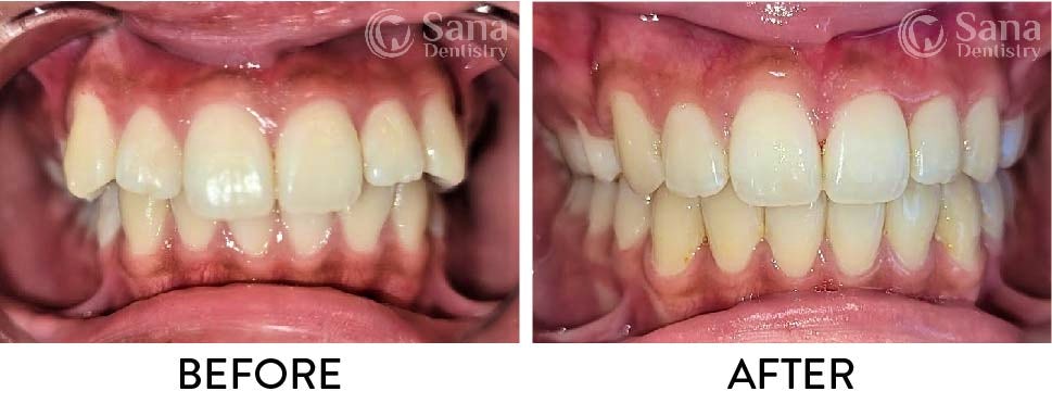 Before and After photos with Invisalign clear aligners