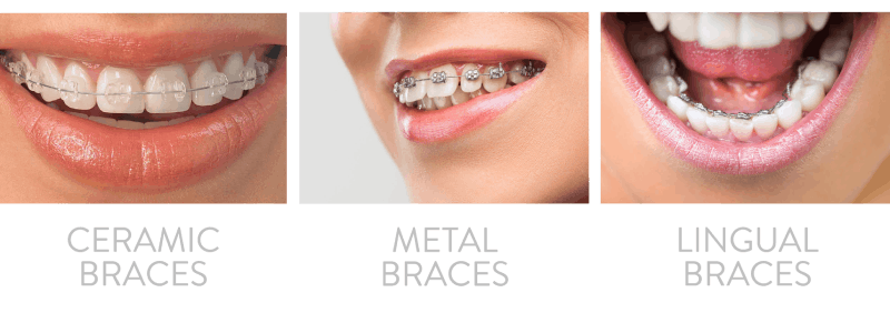 Types of Braces